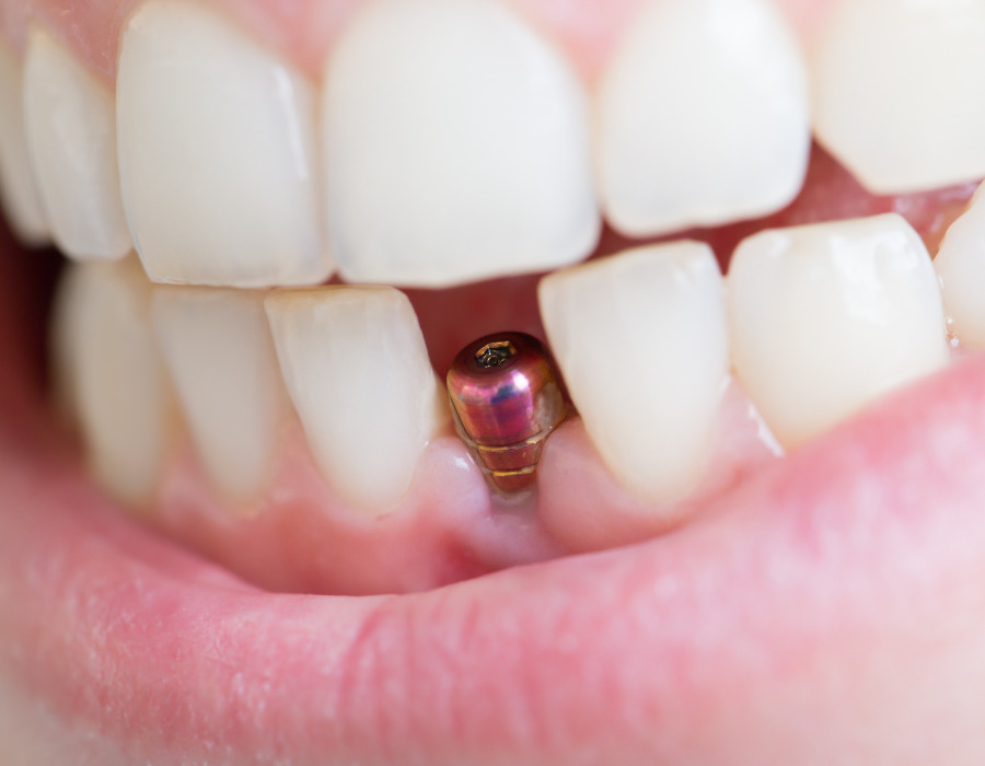 Dental issues and the tooth gap issue
