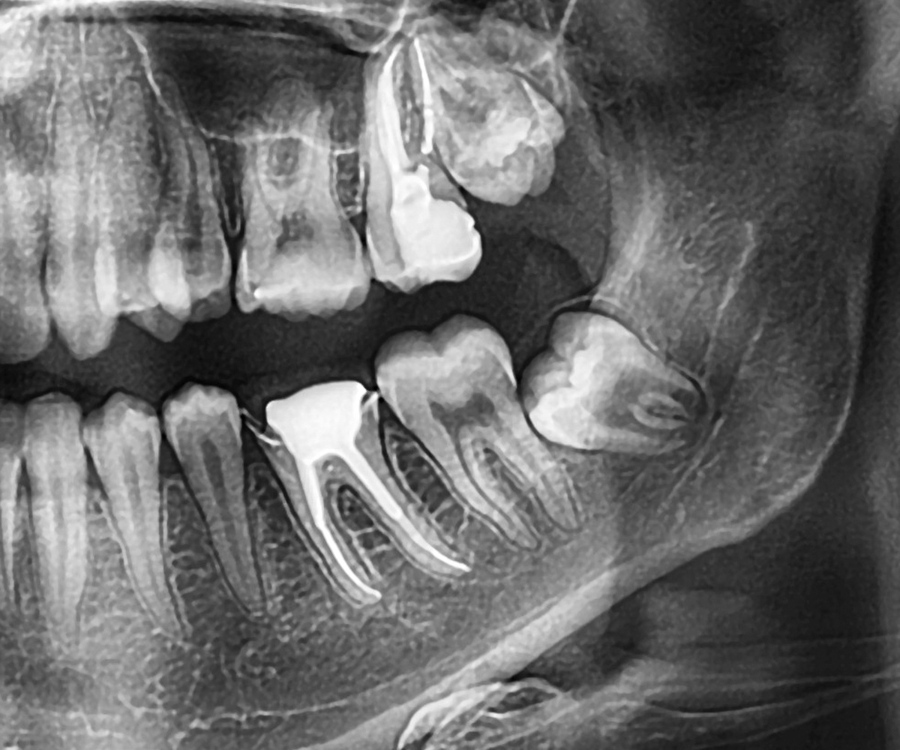 Wisdom Teeth: Wise to Remove, Or Wise to Leave?