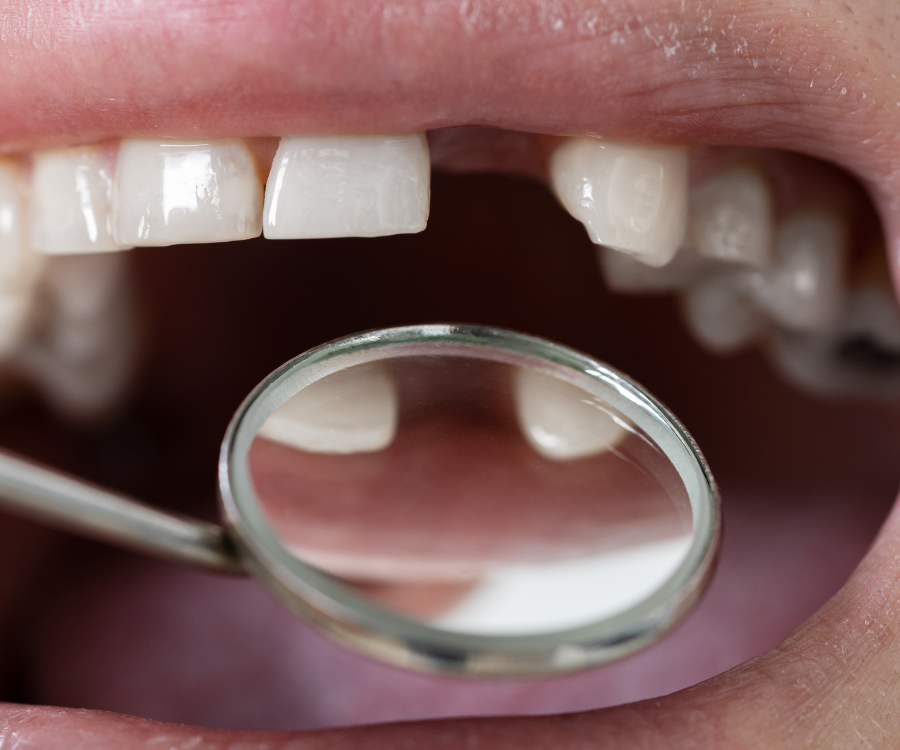 The Importance of Replacing Missing Teeth