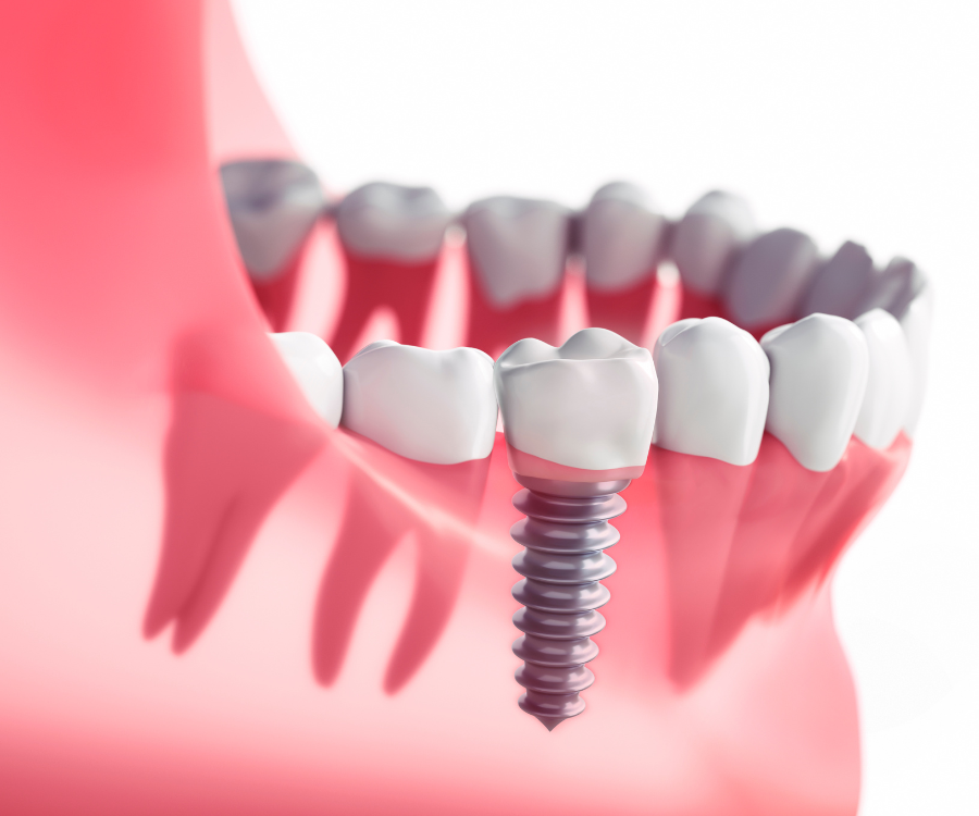 How to Maintain Your Dental Implants