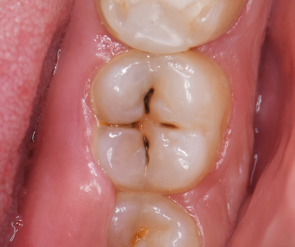 How to prevent cavities naturally