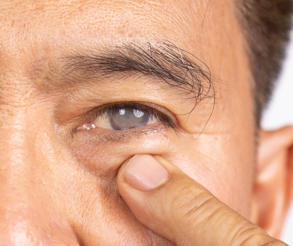 What You Need to Know About Cataracts