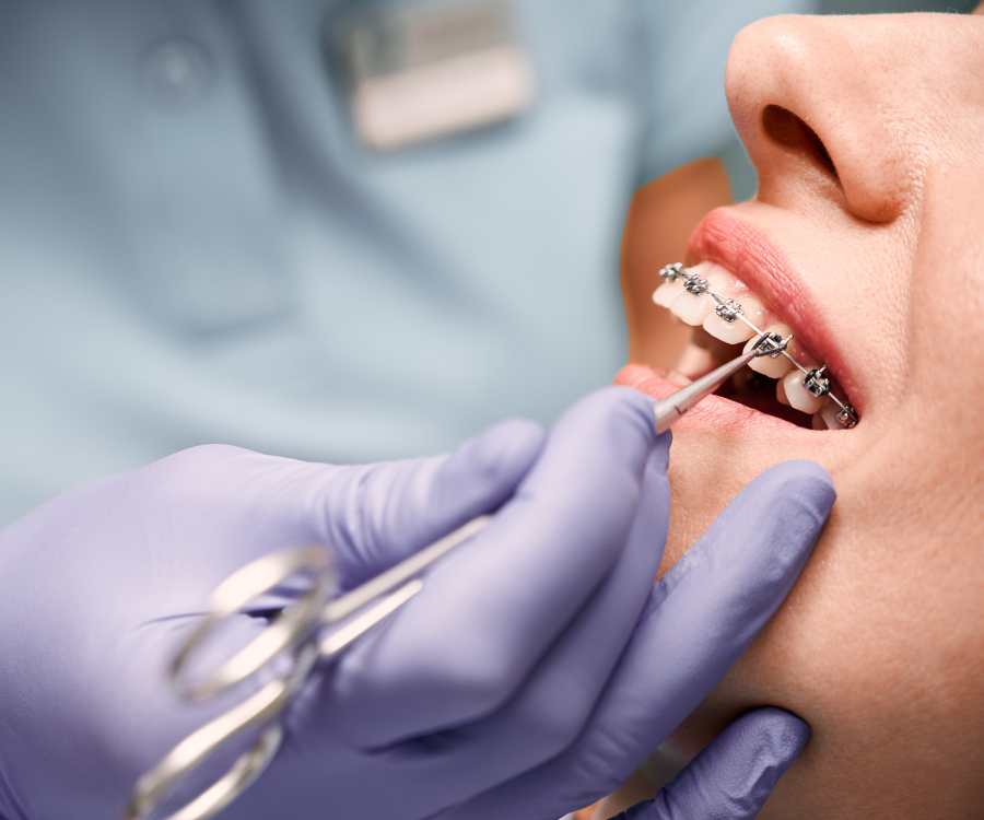 Life with braces: tips for comfort and care