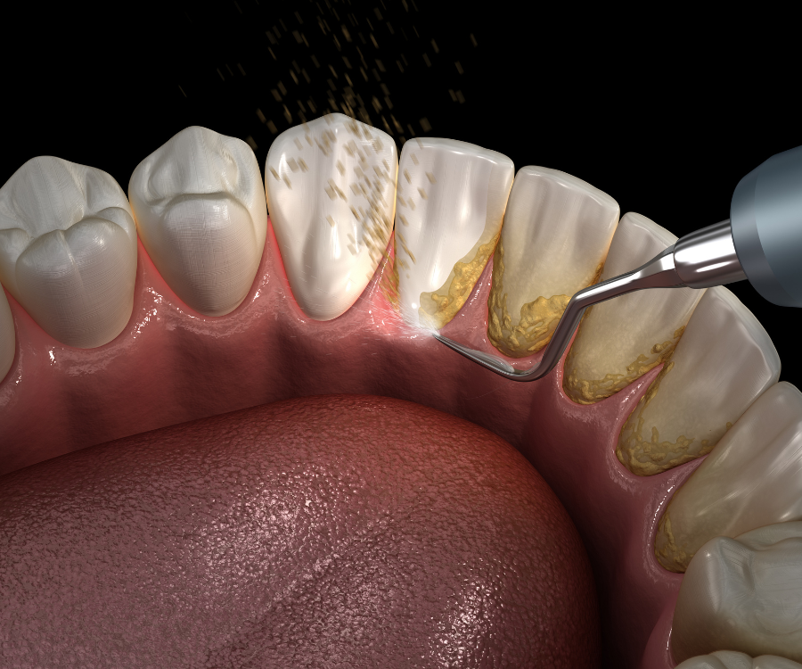 The Hidden Warning Signs: Are You Ignoring Early Gingivitis?